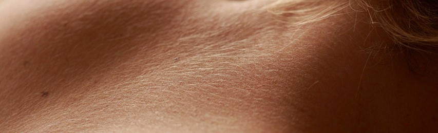 A radioterapia pode causar queimaduras na pele.